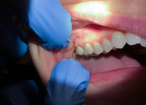 Best Emergency Dental Care for Broken or Chipped Teeth in Utica, SC