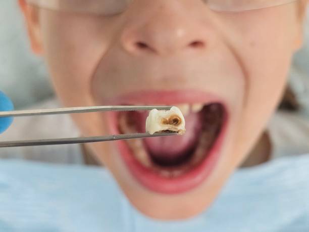 Best Emergency Root Canal Treatment in Utica, SC